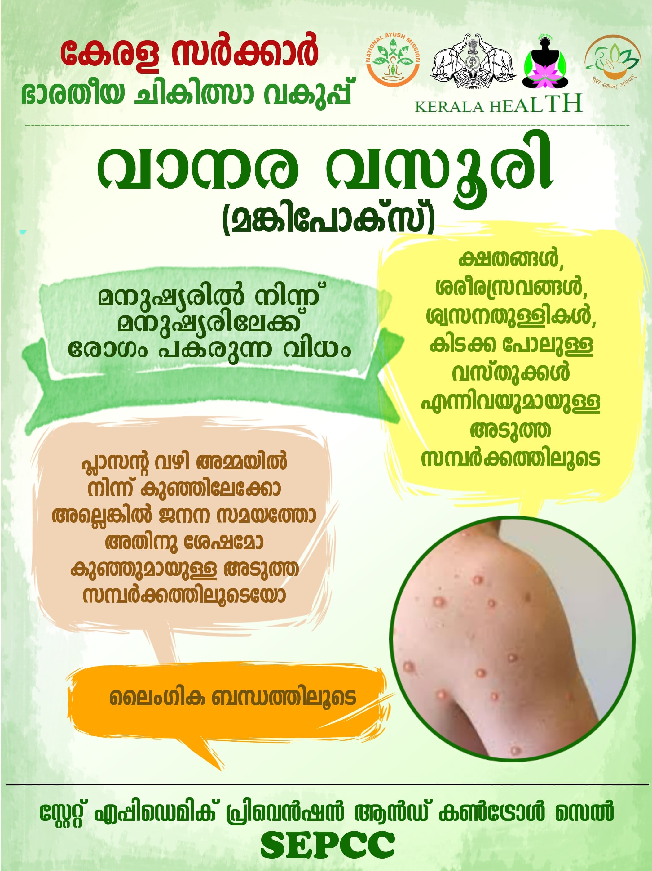 വാനര വസൂരി