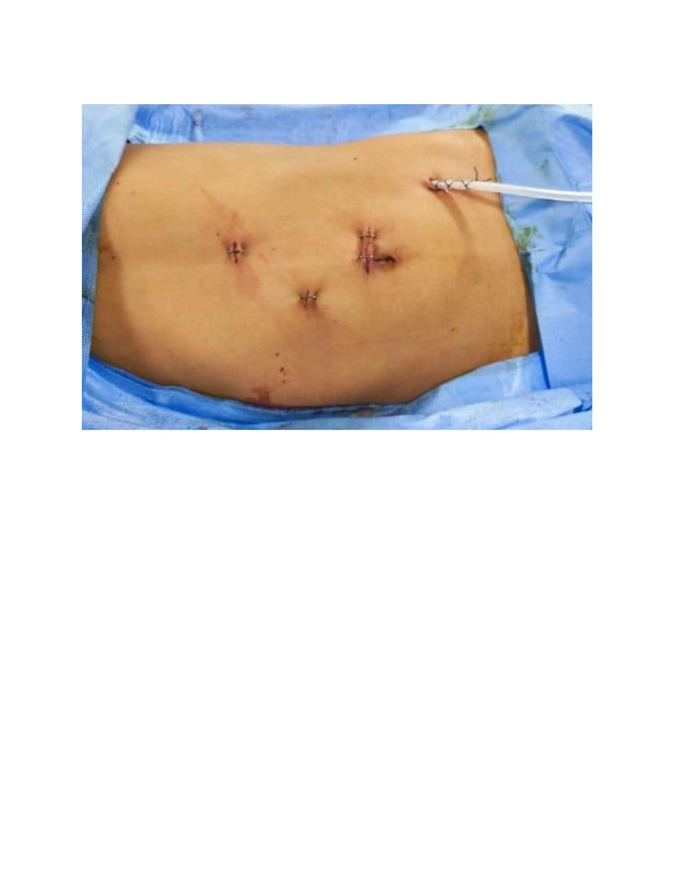 ROBOTIC SURGERY CONDUCTED AT RCC