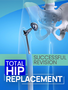 Successful_Revision_Total_Hip_Replacement_at_Vythiri_Taluk_Hospital